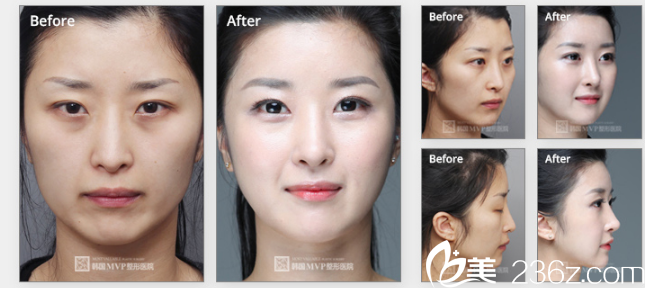 韓國(guó)MVP整形外科醫(yī)院案例 韓國(guó)MVP整形外科醫(yī)院案例