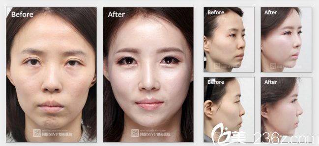 韓國(guó)MVP整形外科醫(yī)院案例 韓國(guó)MVP整形外科醫(yī)院案例