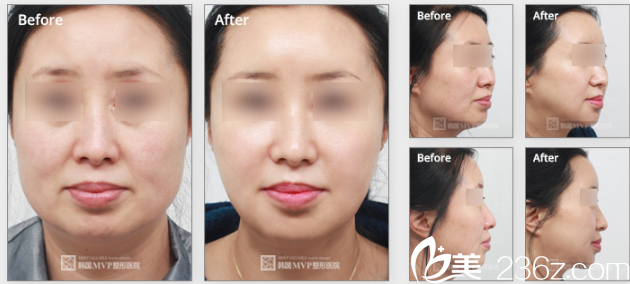 韓國(guó)MVP整形外科醫(yī)院案例 韓國(guó)MVP整形外科醫(yī)院案例