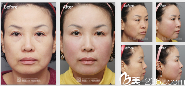 韓國(guó)MVP整形外科醫(yī)院案例 韓國(guó)MVP整形外科醫(yī)院案例