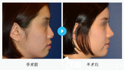 韓國MIGO整形外科醫(yī)院案例 韓國MIGO整形外科醫(yī)院案例