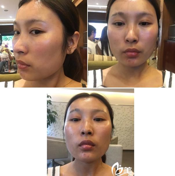 在藝星做假體隆鼻前的三連拍 在藝星做假體隆鼻前的三連拍