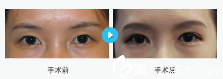 韓國MIGO整形外科醫(yī)院案例 韓國MIGO整形外科醫(yī)院案例