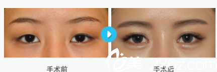 韓國MIGO整形外科醫(yī)院案例 韓國MIGO整形外科醫(yī)院案例