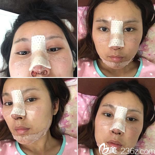 膨體隆鼻手術(shù)第3天和第4天自拍 膨體隆鼻手術(shù)第3天和第4天自拍