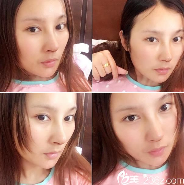 鼻綜合BSK宮廷隆鼻手術(shù)7天拆線 鼻綜合BSK宮廷隆鼻手術(shù)7天拆線