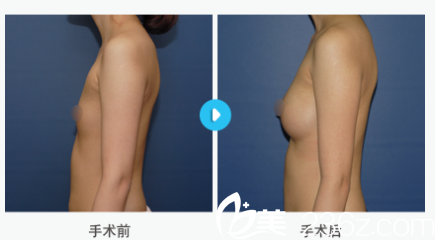 韓國MIGO整形外科醫(yī)院案例 韓國MIGO整形外科醫(yī)院案例