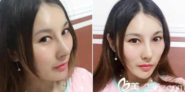 杭州藝星鼻綜合整形20天<span style= 杭州藝星鼻綜合整形20天<span style=