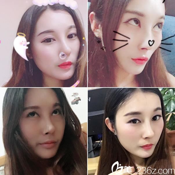 鼻綜合和下巴整形手術(shù)60天<span style= 鼻綜合和下巴整形手術(shù)60天<span style=