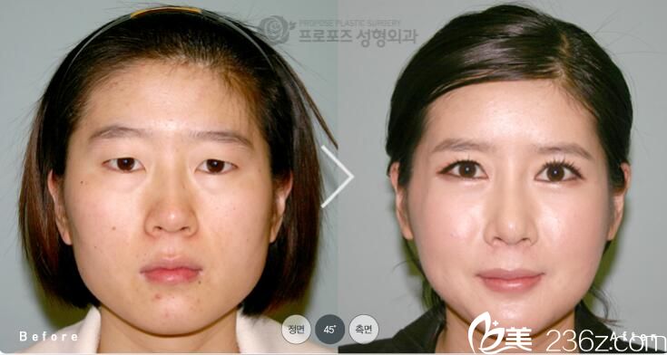 韓國PROPOSE整形醫(yī)院金志昱做下巴縮小手術(shù)效果怎么樣？方下巴縮小真人案例