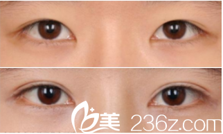 韓國MVP整形醫(yī)院案例 韓國MVP整形醫(yī)院案例