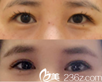 韓國MVP整形醫(yī)院案例 韓國MVP整形醫(yī)院案例