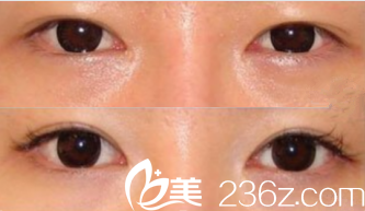 韓國MVP整形醫(yī)院案例 韓國MVP整形醫(yī)院案例