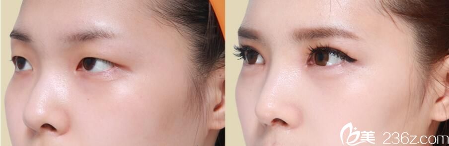 韓國佳輪韓整形外科樸魯爀真人案例3 韓國佳輪韓整形外科樸魯爀真人案例3