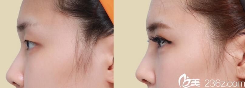 韓國佳輪韓整形外科樸魯爀真人案例2 韓國佳輪韓整形外科樸魯爀真人案例2