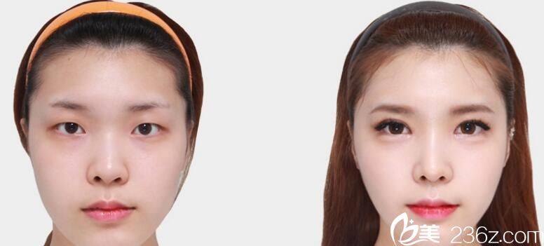 韓國佳輪韓整形外科樸魯爀做鼻子好不好？鷹鉤鼻矯正真人案例