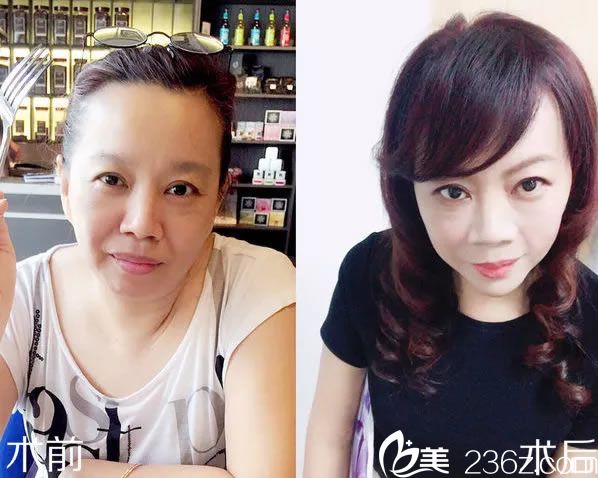 溫州藝興面部玻尿酸填充<span style= 溫州藝興面部玻尿酸填充<span style=