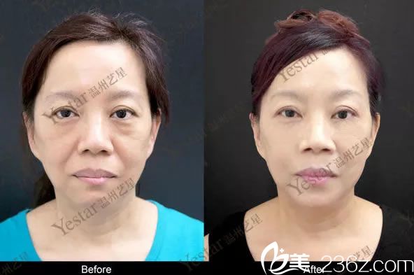 玻尿酸填充全面部<span style= 玻尿酸填充全面部<span style=