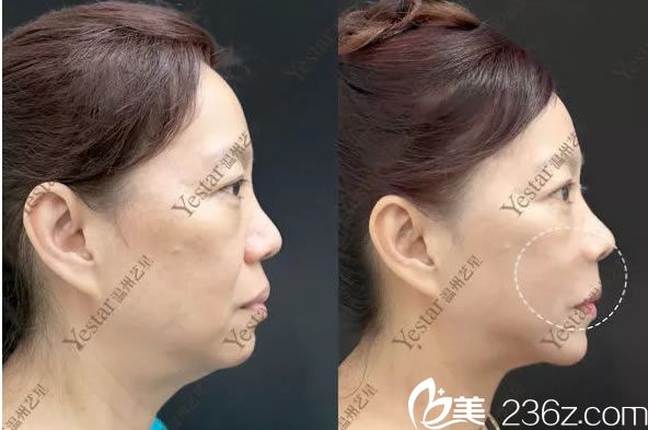 溫州藝興激光除皺<span style= 溫州藝興激光除皺<span style=