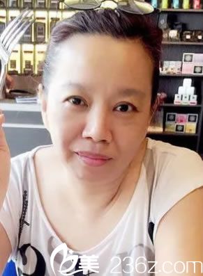 溫州藝星醫(yī)學(xué)美容醫(yī)院劉楊術(shù)前照片1