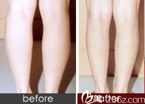 吸脂瘦小腿術(shù)前術(shù)后對(duì)比圖