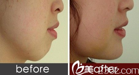 431假體豐下巴前后對比圖