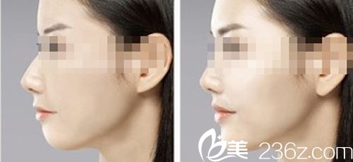 431玻尿酸豐下巴前后對比圖