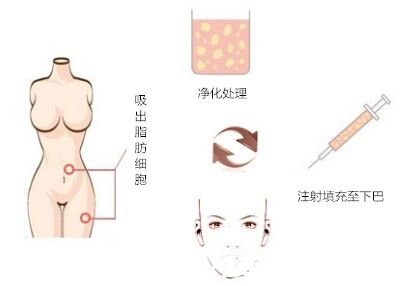 431自體脂肪豐下巴原理