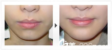 431自體脂肪豐下巴前后對比圖