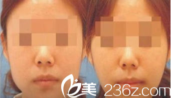 韓國ITEM（愛婷）整形醫(yī)院案例