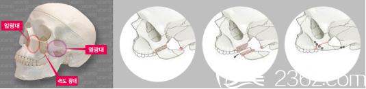 韓國UcanB整形外科醫(yī)院院長金駿昊對顴骨手術(shù)的講解 韓國UcanB整形外科醫(yī)院院長金駿昊對顴骨手術(shù)的講解