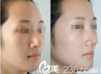 韓國ITEM(愛婷)整形醫(yī)院案例 韓國ITEM(愛婷)整形醫(yī)院案例