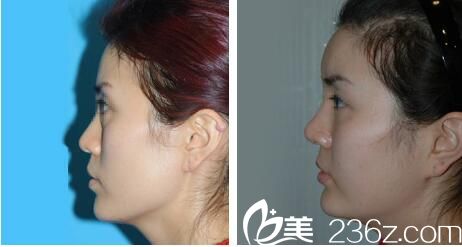 韓國樸宰佑整形外科美容醫(yī)院自體脂肪移植案例