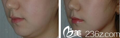 韓國樸宰佑整形外科美容醫(yī)院激光溶脂術案例