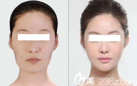 韓國ITEM(愛婷)整形醫(yī)院案例 韓國ITEM(愛婷)整形醫(yī)院案例