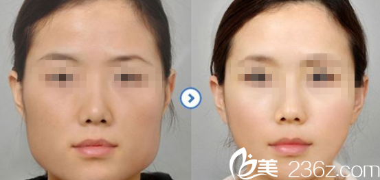 韓國ITEM(愛婷)整形醫(yī)院案例 韓國ITEM(愛婷)整形醫(yī)院案例