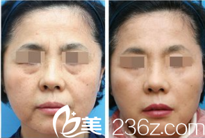 韓國ITEM(愛婷)整形醫(yī)院案例 韓國ITEM(愛婷)整形醫(yī)院案例