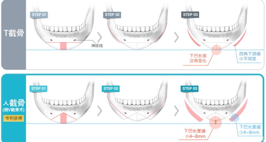 V-line四角下頜手術(shù)