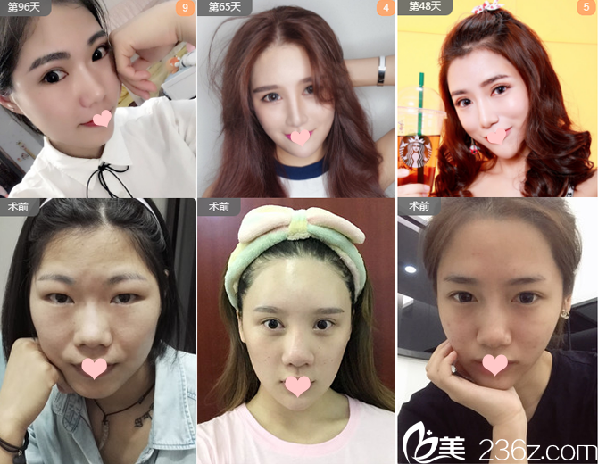 廣州軍美整形醫(yī)院王世虎隆鼻<span style=