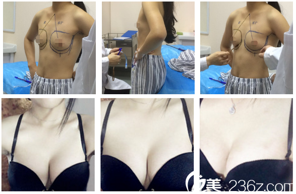 廣州軍美整形醫(yī)院王世虎隆胸<span style=