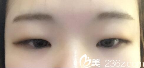 韓國樸宰佑整形外科樸宰佑真人案例圖1 韓國樸宰佑整形外科樸宰佑真人案例圖1