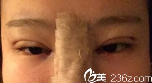 韓國樸宰佑整形外科樸宰佑真人案例圖2 韓國樸宰佑整形外科樸宰佑真人案例圖2