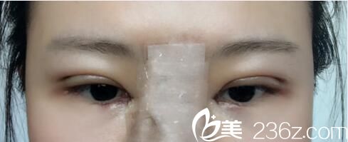 韓國樸宰佑整形外科樸宰佑真人案例圖3 韓國樸宰佑整形外科樸宰佑真人案例圖3