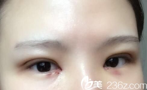 韓國樸宰佑整形外科樸宰佑真人案例圖4 韓國樸宰佑整形外科樸宰佑真人案例圖4