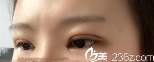 韓國樸宰佑整形外科樸宰佑真人案例圖5 韓國樸宰佑整形外科樸宰佑真人案例圖5