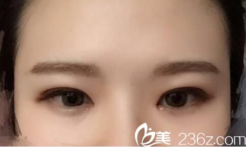   韓國(guó)樸宰佑整形外科樸宰佑眼睛，鼻子做的好不好？雙眼皮+隆鼻真人案例