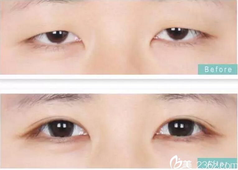 徐輔翊雙眼皮案例 徐輔翊雙眼皮案例