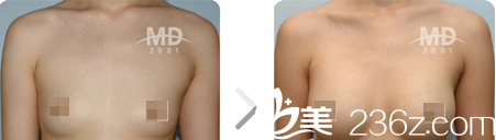 韓國MD胸部整形醫(yī)院案例 韓國MD胸部整形醫(yī)院案例