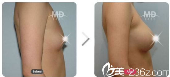 韓國MD胸部整形醫(yī)院案例 韓國MD胸部整形醫(yī)院案例