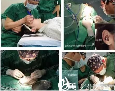 鼻綜合修復(fù)隆鼻失敗 鼻綜合修復(fù)隆鼻失敗